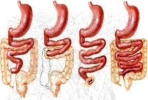 Intestinocorto