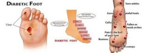 Piede diabetico