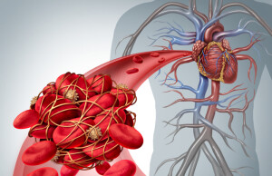 coronaropatia-o-arteriopatia-periferica